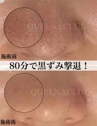 お肌トータルケア【毛穴改善ケア&小顔フェイシャル&ヘッドマッサージ&アロマオイルで首肩背中腕ほぐし】￥13000