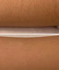 ジュニア脱毛(小、中学生)腕上下+脚上下