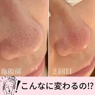 【小鼻の毛穴エクストラクション➕小顔コルギ】美肌と小顔で変化整形級✨脱マスクにむけて❤️