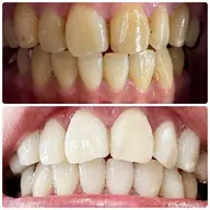 お試しセルフホワイトニング1照射¥3500