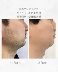 メンズ ヒゲ脱毛