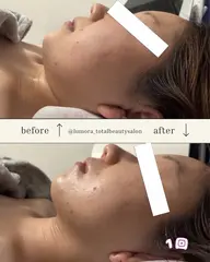 本気で小顔になりたい方🔥話題のマシーンで即小顔🌸✨💫