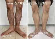 初回限定🌟男性脚or腕セット脱毛👨通常¥10,000→¥5,000‼️（肘上下•手甲指）or（膝上下•足甲指）