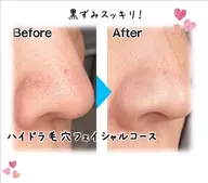 【メンズ限定】毛穴ケア(顔)