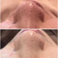 当店人気No.2メニュー✨️ 【 毛穴・美肌トーンupケア 】 REVIハーブピーリング🌿