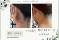 【🍉夏限定🌊】うなじ脱毛🌈🦴