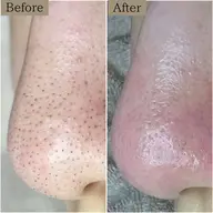 《鼻のみ》【黒ずみ毛穴ケア・毛穴洗浄】黒ずみに悩まない毛穴ケア＆肌づくり◉初回8500円