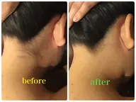 最新ハイブリッド脇脱毛✨