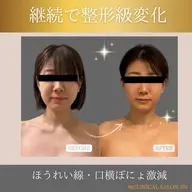 小顔フルコース120分✨たるみ・小顔専門サロン