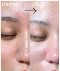 ⭐️ミニモ学割⭐️【全顔】毛穴エクストラクション60分 (小鼻周り•ホホ•オデコ•顎•眉間/黒ずみ/詰まり/開き)