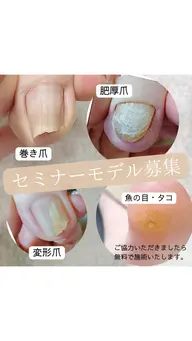 【通常24,200円→無料】巻き爪・肥厚爪・変形爪・魚の目・タコ・角質セミナーモデル募集📣