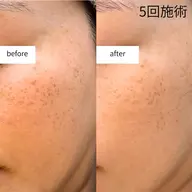 【平日16:00-21:00枠限定10%OFF】シミケア