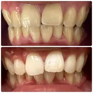 初回ナチュラルホワイトニング（美容ホワイトニング）