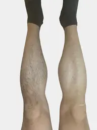 【安く脱毛したい方必見！】ボディ脱毛回数：1回