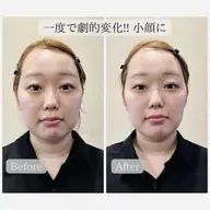 🌟人気NO.1🌟【骨格から美眉毛に💎🫧】小顔矯正＆美眉WAXスタイリング＆バブル保湿パック 仙台/あおば通駅