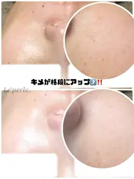 毛穴エクストラクション✖️ハーブピーリングで最強美肌☆モニター様募集☆