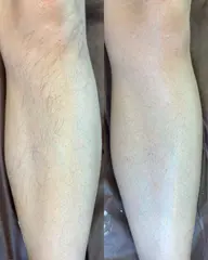 【ひざ下WAX脱毛】ツルスベ美脚へ