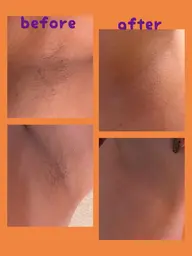 【両脇】男性女性どちらも歓迎！！ブラジリアンWaxまたは光脱毛🧡即日ツルツルへ✨※どちらかご希望の上、メッセージ下さい