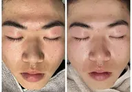 メンズに大人気メニューminimoだけの特別価格！！￥5,500→￥4,400！！角栓ごっそり取れる！毛穴お掃除！60分