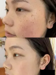 シミ、イボ、ホクが気になる方(2ミリ１ケ)