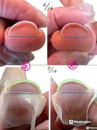 【巻き爪モデル】巻き爪施術