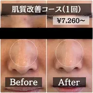 【ミニモ限定】開き/黒ずみ/たるみ毛穴 毛穴レスでツルスベ肌に♪肌質改善マッサージピール¥9,900→¥7,280