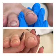 【巻き爪ケア】1本