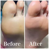 【冬の乾燥でひび割れかかと🦶】つるんと艶かかと集中ケア