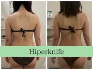 【モニター2名様限定‼️】✨すっきり小顔✨ハイパーナイフEX 顔🔥 ⚠️口コミ必須