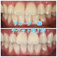 １カ月通い放題✋ホワイトニング1回20分💛早く白くなりたい方はぜひ😋