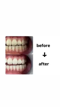 セルフホワイトニング 1日集中コース