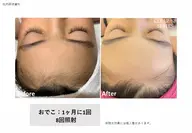 【レディース・お顔丸ごと脱毛】うぶ毛すっきりお肌ワントーンアップ！保湿パック付き️✨️