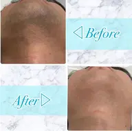 先着5名様!!【1回で抜ける】ヒゲ★ハイスペック脱毛¥3600