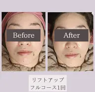 リフトアップフルコース❣️話題のサーマトリックスの効果をぜひお試し下さい🌟