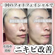 《凸凹肌・毛穴の開き・ニキビケアでお悩みの方》光フェイシャル