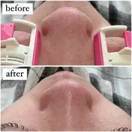 【大人気!インスタフォロワー様限定クーポン①】プレミアム毛穴洗浄付 4,250円