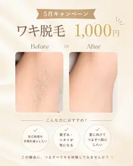 5月限定キャンペーン✨ワキ脱毛1回¥1,000‼️