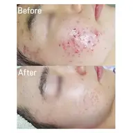 「毛穴・肌をリセットして立て直す!」577万本植え込みハーブピーリング【トロイピール】