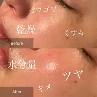 ハーブピーリング1ヶ月以内でご来店のお客様