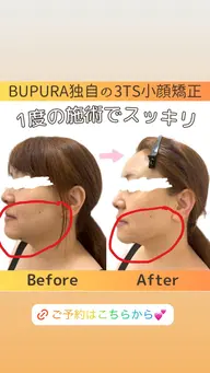 【徹底小顔＋毛穴洗浄♪】BUPURA式頭蓋骨小顔骨格矯正＋毛穴洗浄