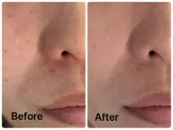 【♡NEW メニュー♡】ソフトピーリングで透明感トーンUP➕角質ケア😊月1ケアで毛穴黒ずみにサヨナラ‼️