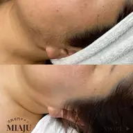 お顔のワックス脱毛+お仕上げ