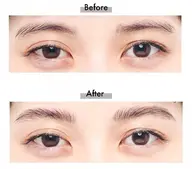 美眉矯正＋眉毛wax脱毛