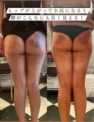 カッピング痩身 下半身 25分