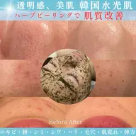 肌質改善🌿〜水光肌へ〜剥離なし幹細胞ハーブピーリング60分