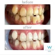 【カムバッククーポン】セルフホワイトニング1セット40分¥8980→¥3980