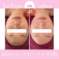 REVIハーブピーリング🌿くすみ改善・透明感のあるお肌に♪※カウンセリングは無料。施術体験される方は¥8,800