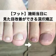 即日見た目改善ができるフット深爪矯正の練習モデルです。