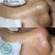 【脱✨いちご鼻】毛穴エクストラクション癒やしのマッサージ込み(施術時間90分)