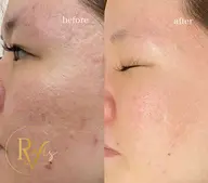 【どんな肌悩みにも対応‼️】プロセルフェイシャル全顔✨️毛穴の開き、ニキビ跡、凸凹肌、シミしわ、たるみ、後戻りなし最新術